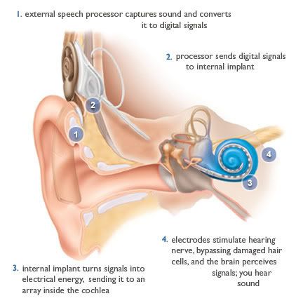 descriptionofcochlear.jpg