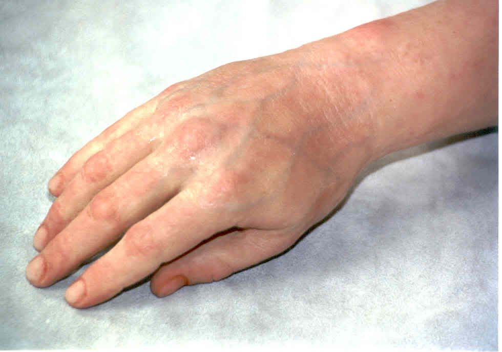 ProstheticArm1.jpg