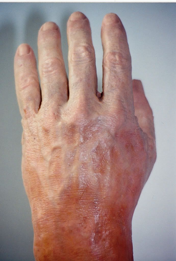 ProstheticHand3.jpg